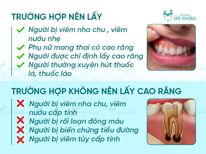 Trường hợp nên và không nên lấy cao răng