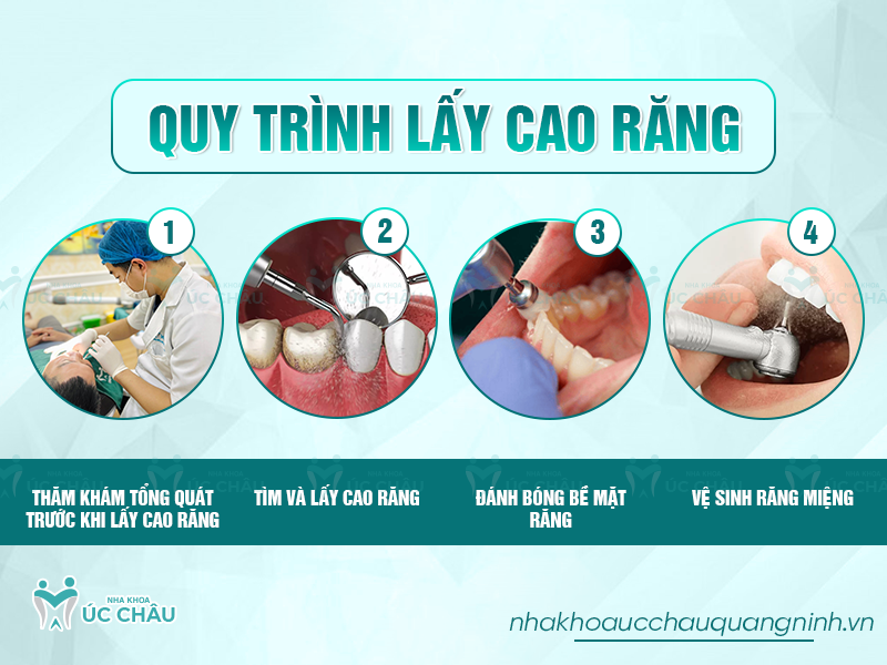 Quy trình lấy cao răng