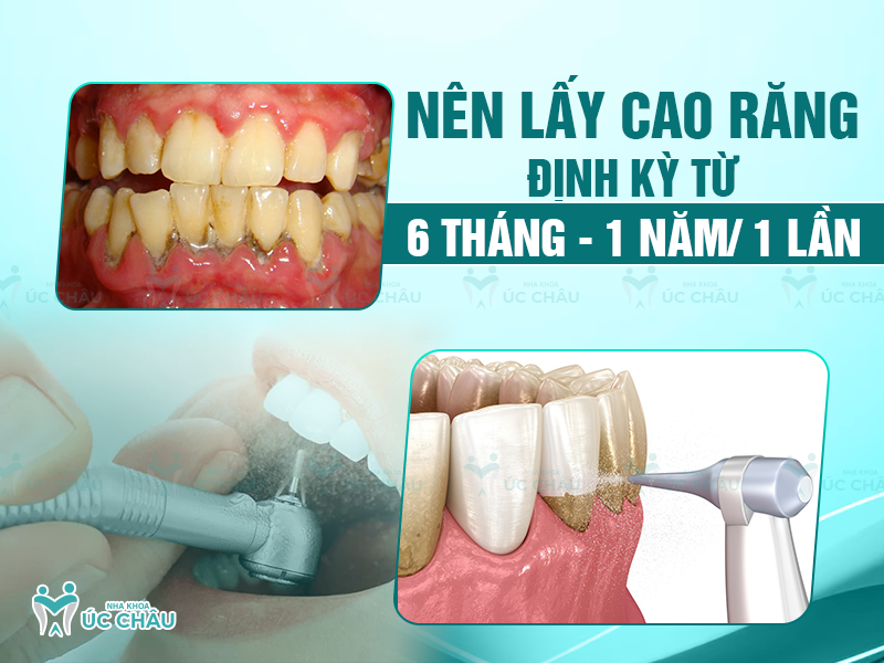 Nên lấy cao răng định kỳ từ 6 tháng - 1 năm/ 1 lần