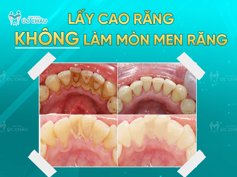 Lấy cao răng KHÔNG làm mòn men răng