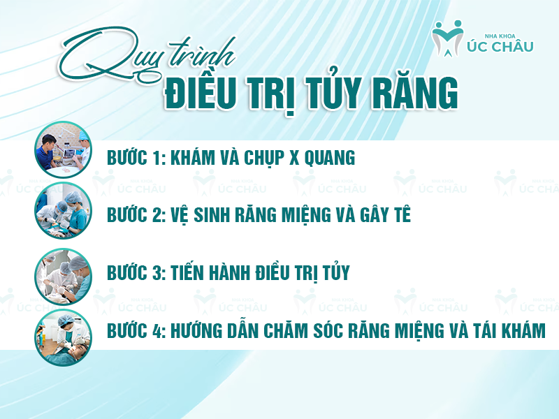 Quy trình điều trị tủy răng 