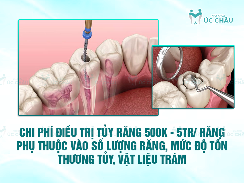 Chi phí điều trị tủy răng 500K - 5tr/ răng phụ thuộc vào số lượng răng, mức độ tổn thương tủy, vật liệu trám