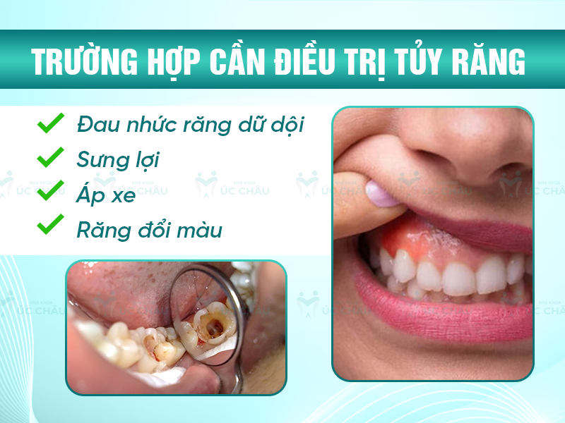 Trường hợp cần điều trị tủy răng