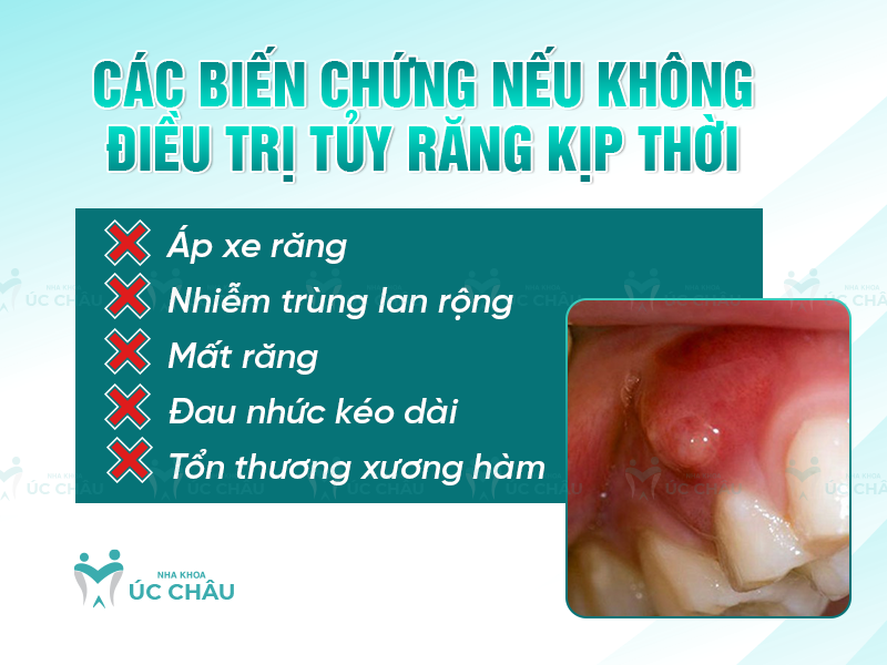 Các biến chứng nếu không điều trị tủy răng kịp thời 