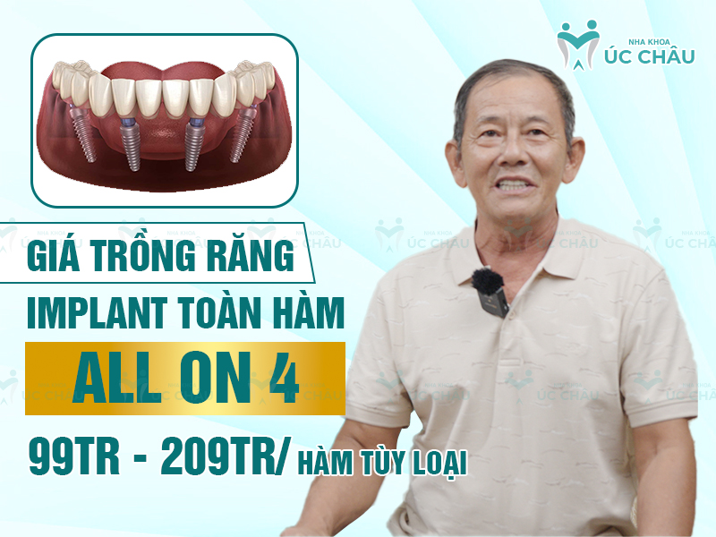 Giá trồng răng Implant toàn hàm All On 4 99tr - 209tr/ hàm tùy loại