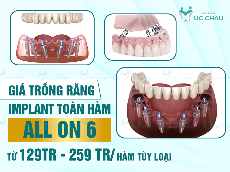 Giá trồng răng Implant toàn hàm All On 6 từ 129tr - 259 tr/ hàm tùy loại