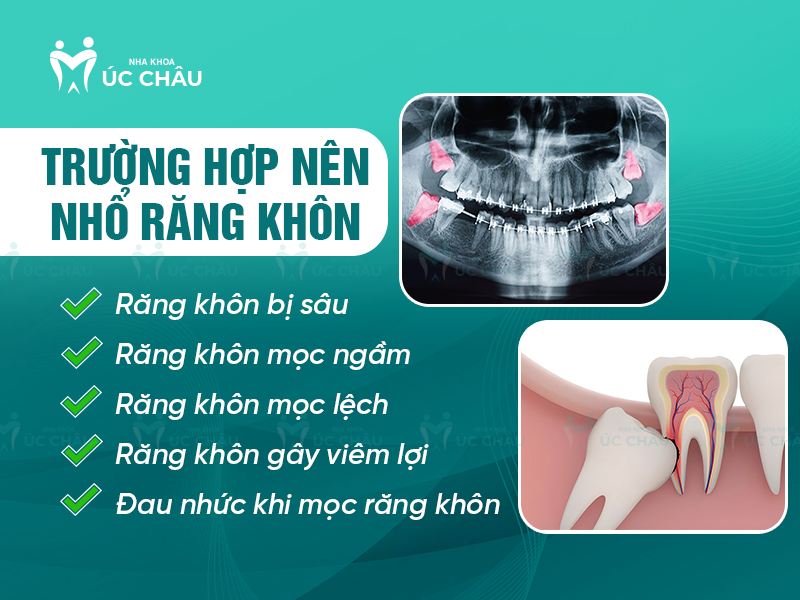 Trường hợp nên nhổ răng khôn