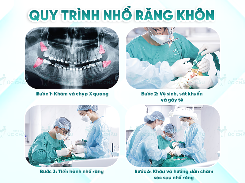 Quy trình nhổ răng khôn