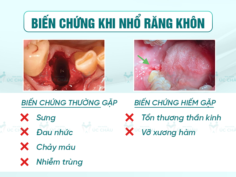 Biến chứng khi nhổ răng khôn