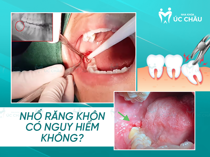 Nhổ răng khôn có nguy hiểm không