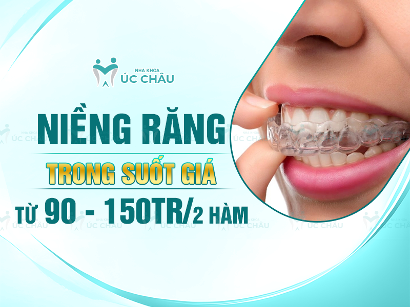 Niềng răng trong suốt giá từ 90 - 150tr/ 2 hàm