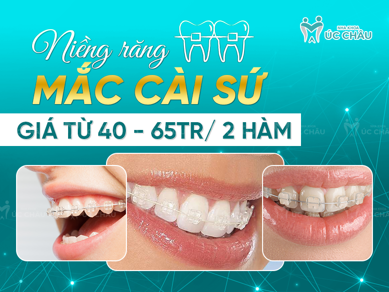 Niềng răng mắc cài sứ giá từ 40 - 65tr/ 2 hàm