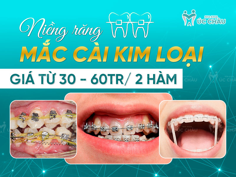 Niềng răng mắc cài kim loại giá từ 30 - 60tr/ 2 hàm