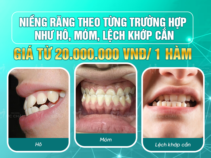 Niềng răng theo từng trường hợp như hô, móm, lệch khớp cắn giá từ 20.000.000 VNĐ/ 1 hàm