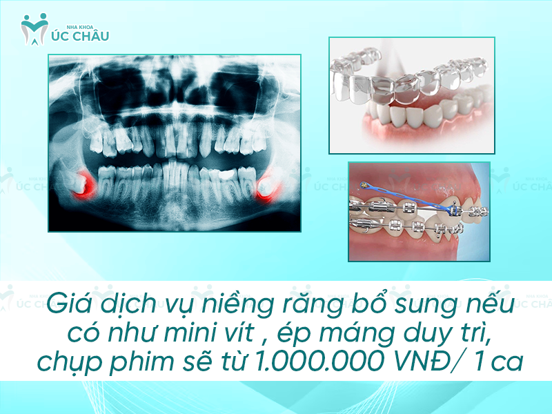 Giá dịch vụ niềng răng bổ sung nếu có như mini vít , ép máng duy trì, chụp phim sẽ từ 1.000.000 VNĐ/ 1 ca 