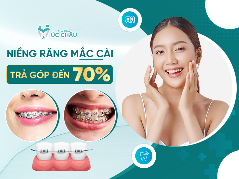 Niềng răng trả góp đến 70%