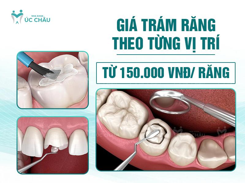 Giá trám răng theo từng vị trí từ 150.000 VNĐ - 1.500.000 VNĐ/ răng