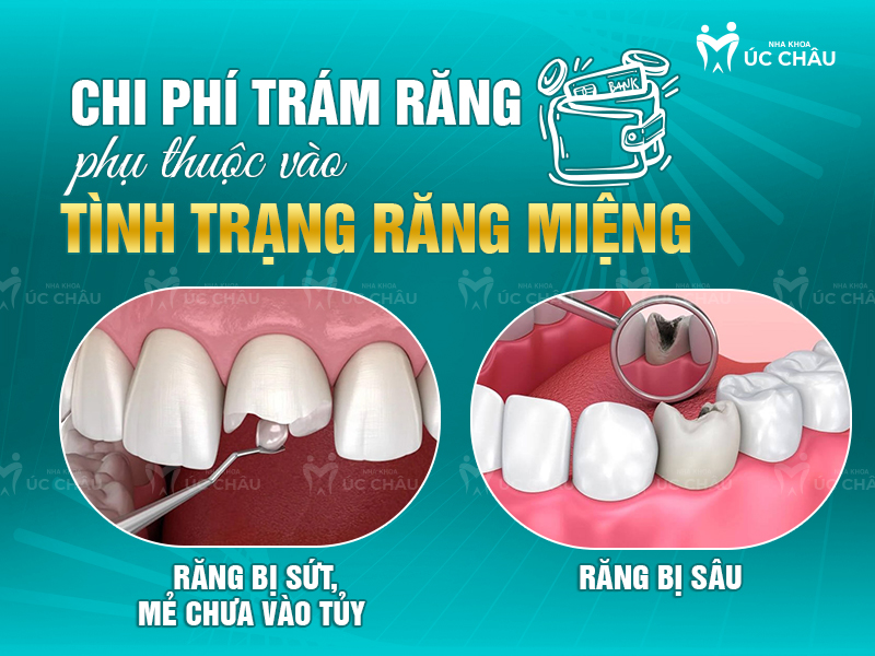 Chi phí trám răng phụ thuộc vào tình trạng răng miệng 