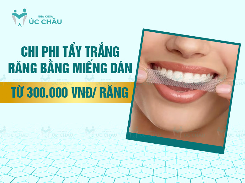 Chi phi tẩy trắng răng bằng miếng dán từ 300.000 VNĐ/ răng