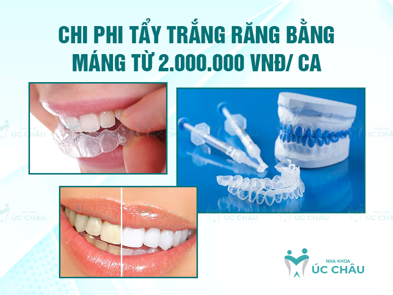 Chi phi tẩy trắng răng bằng máng từ 2.000.000 VNĐ/ ca