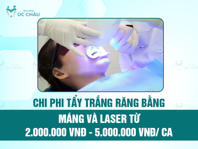 Chi phi tẩy trắng răng bằng máng và laser từ 2.000.000 VNĐ - 5.000.000 VNĐ/ ca