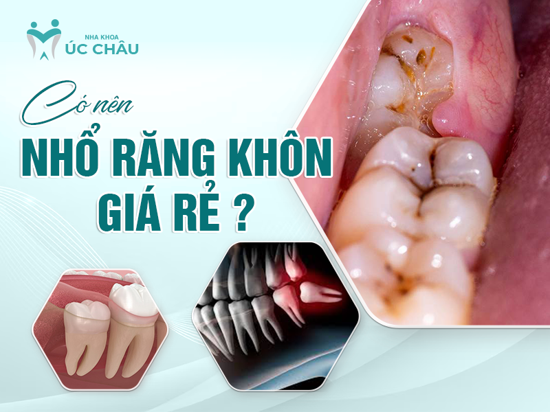 Có nên nhổ răng khôn giá rẻ? 