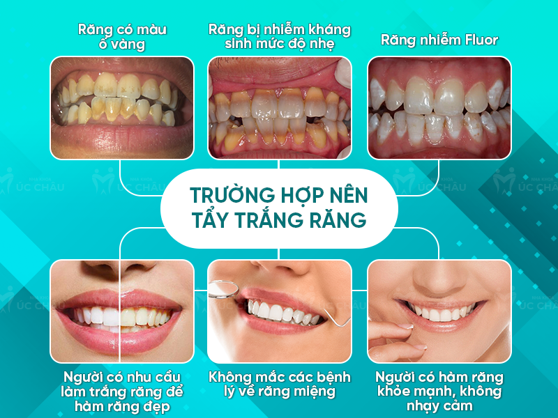 Trường hợp nên tẩy trắng răng