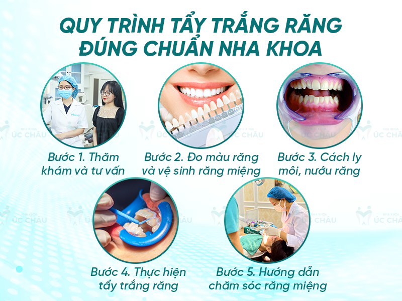 Quy trình tẩy trắng răng đúng chuẩn nha khoa