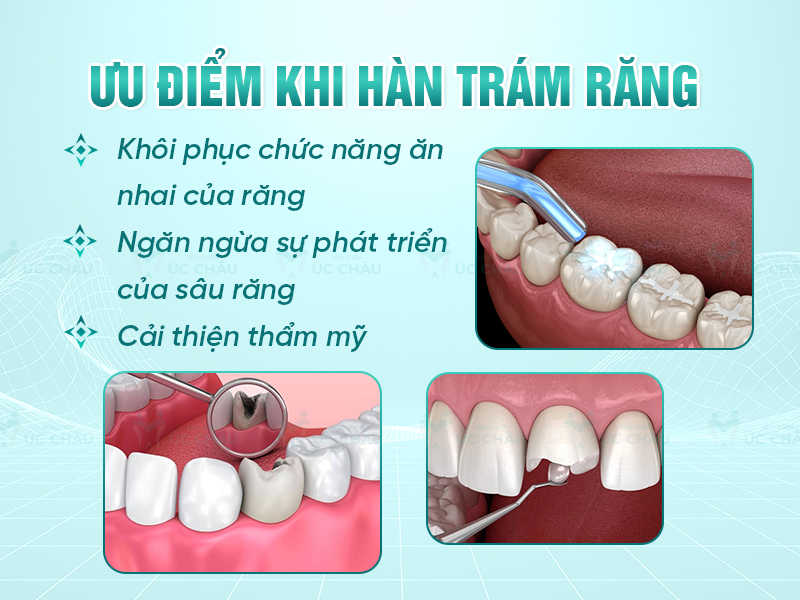 Ưu điểm khi hàn trám răng