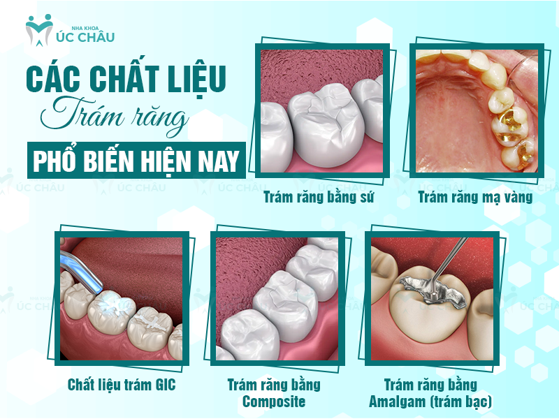 Các chất liệu trám răng phổ biến hiện nay