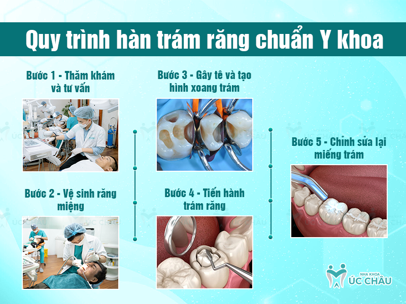 Quy trình hàn trám răng chuẩn Y khoa